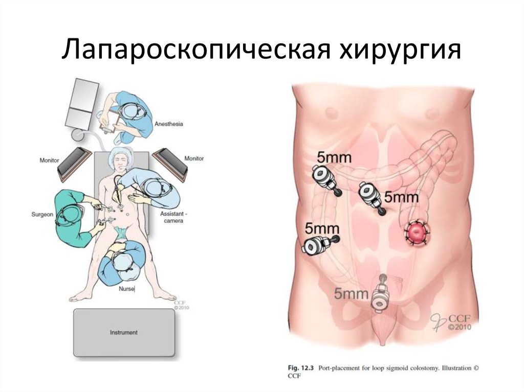 Колостома двуствольная схема