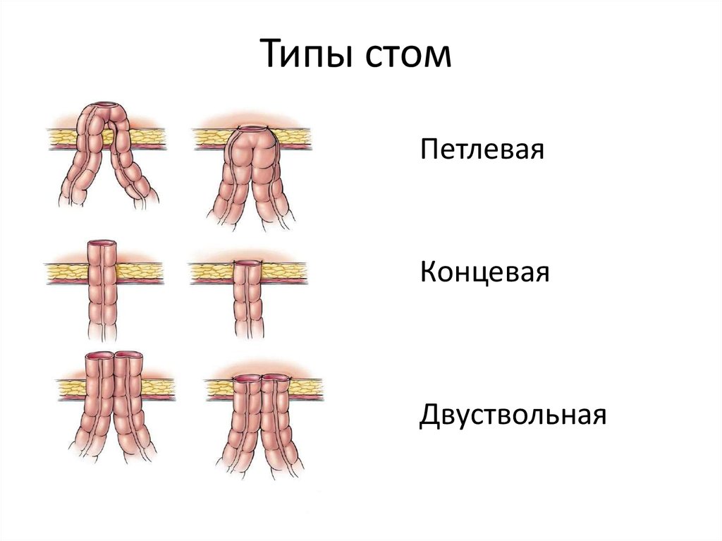 Колостома двуствольная схема