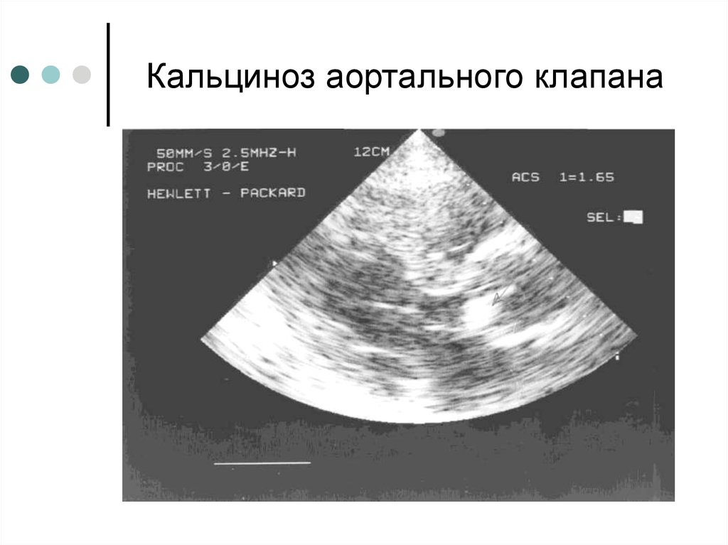 Фиброз клапанов