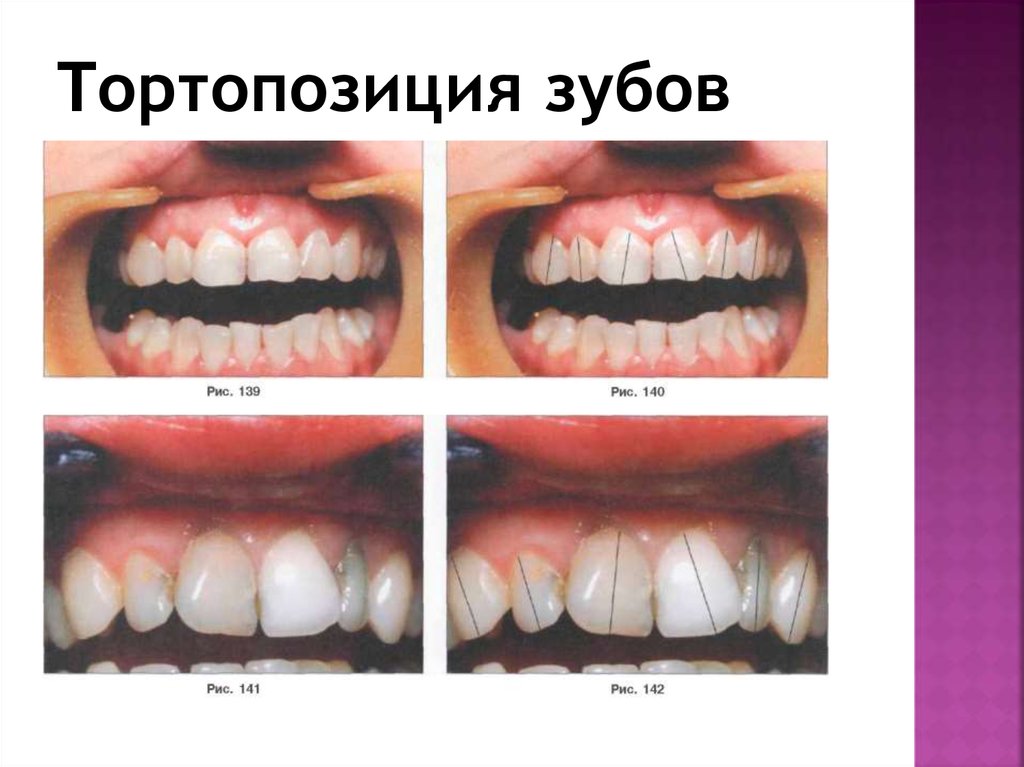Тортопозиция зубов