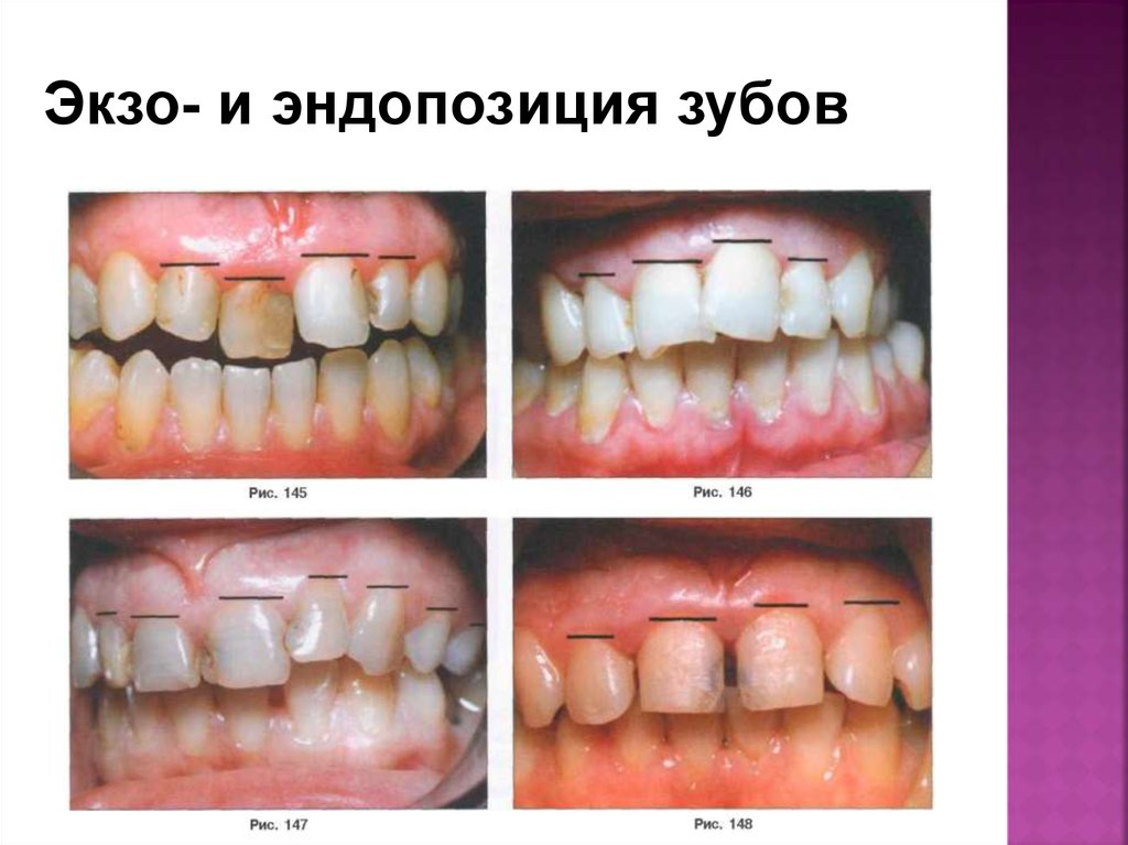 Аномалии развития зубов и челюстей - презентация онлайн