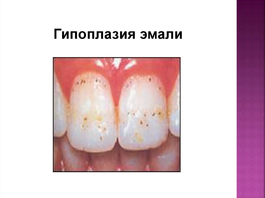 Гипоплазия эмали