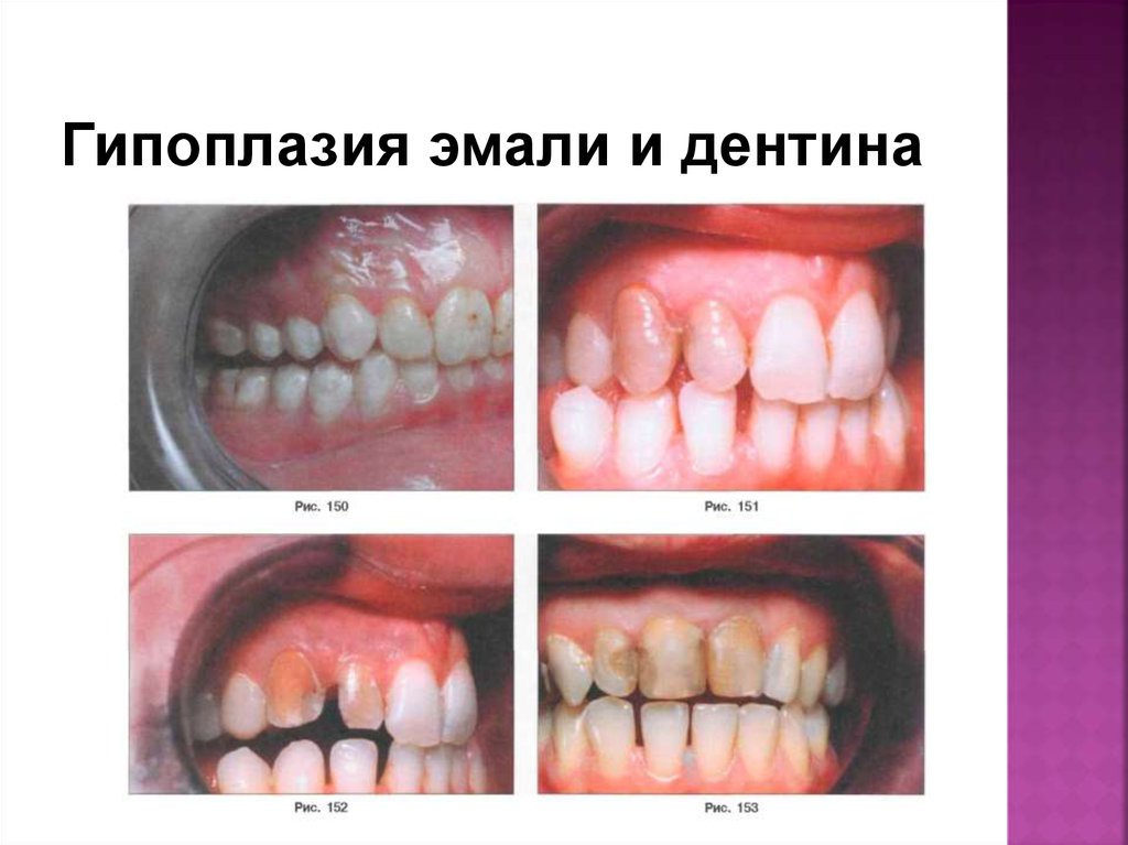 Гипоплазия эмали и дентина