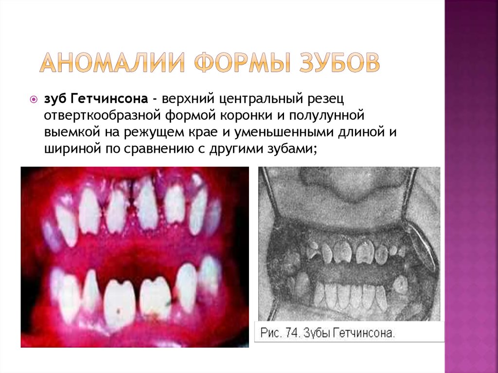 Аномалии развития зубов и челюстей - презентация онлайн