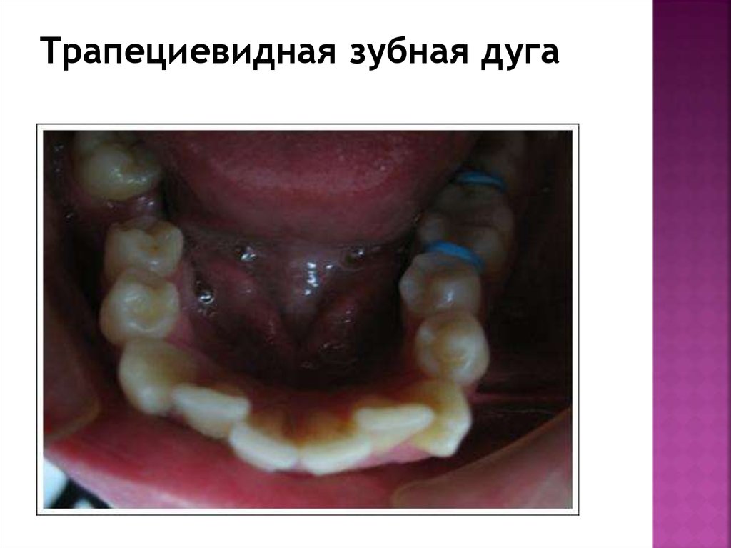 Трапециевидная зубная дуга