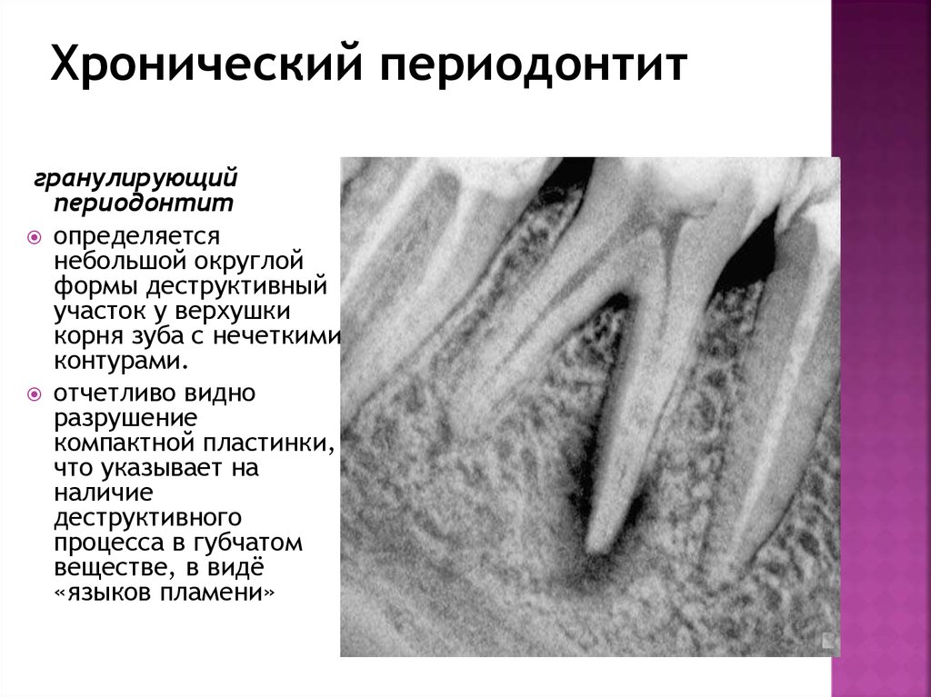 Хронический периодонтит