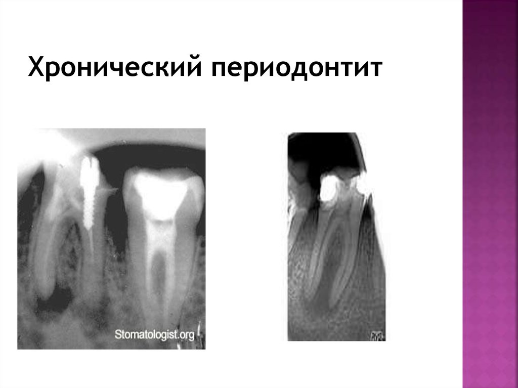 Рентгенологические признаки периодонтита