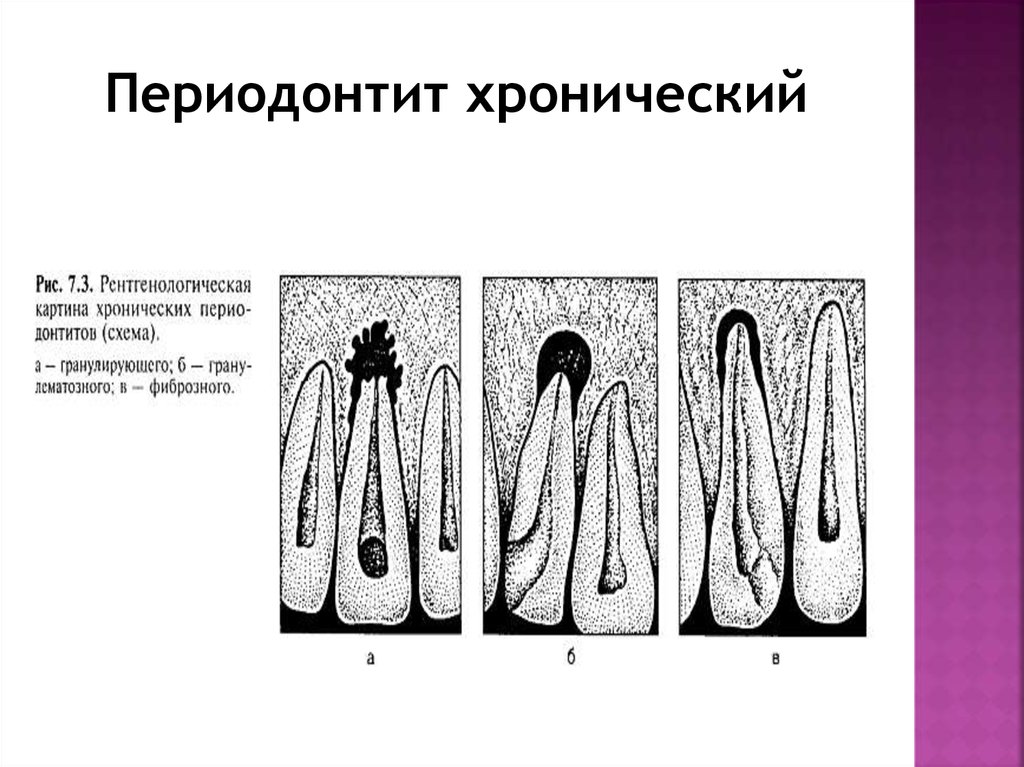 Лечение всех форм периодонтита. Острый верхушечный периодонтит рентген. Гранулирующий периодонтит рентгенограмма. Хронический гранулематозный периодонтит рентген. Хронический апикальный периодонтит рентген.