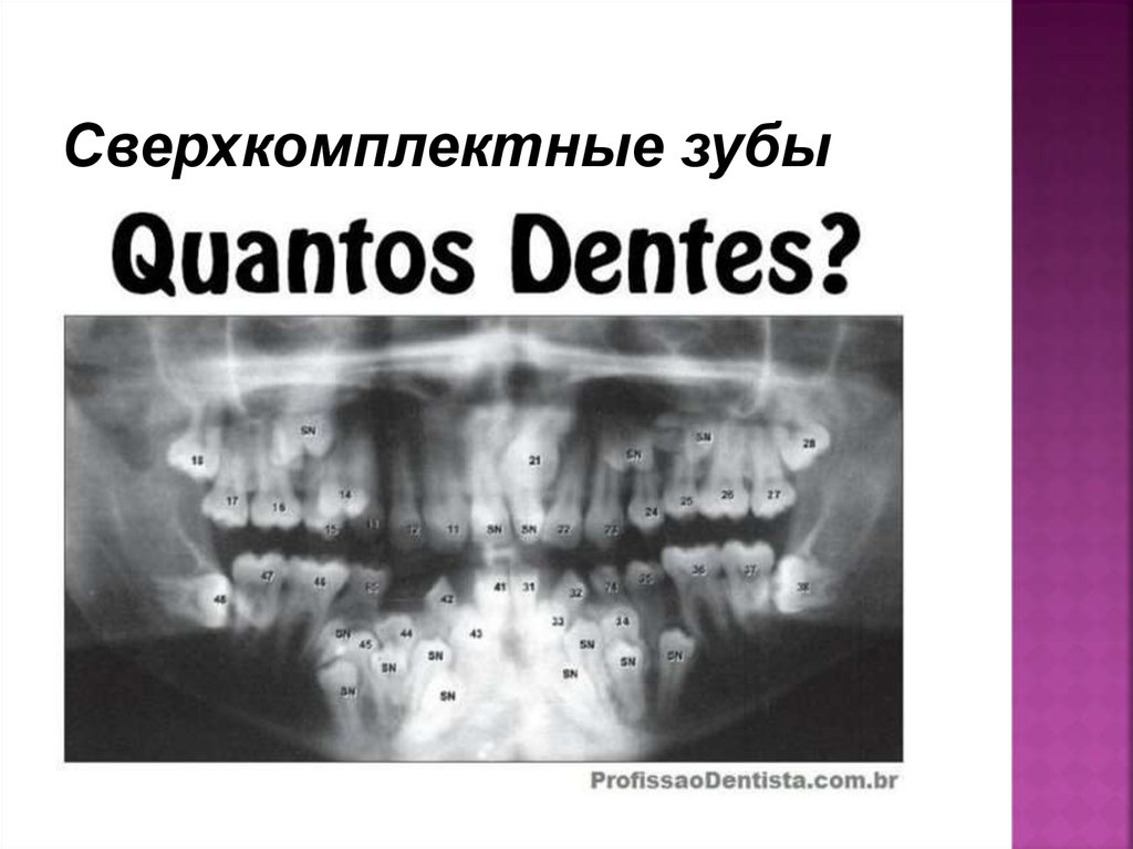 Сверхкомплектные зубы
