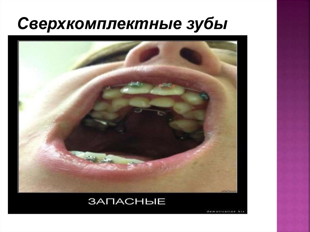 Сверхкомплектные зубы