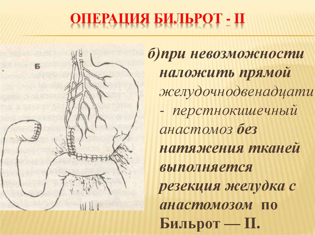 Операция б 2. Бильрот 1 схема операции. Резекция желудка Бильрот 2. Операция по Бильрот 2 показания.