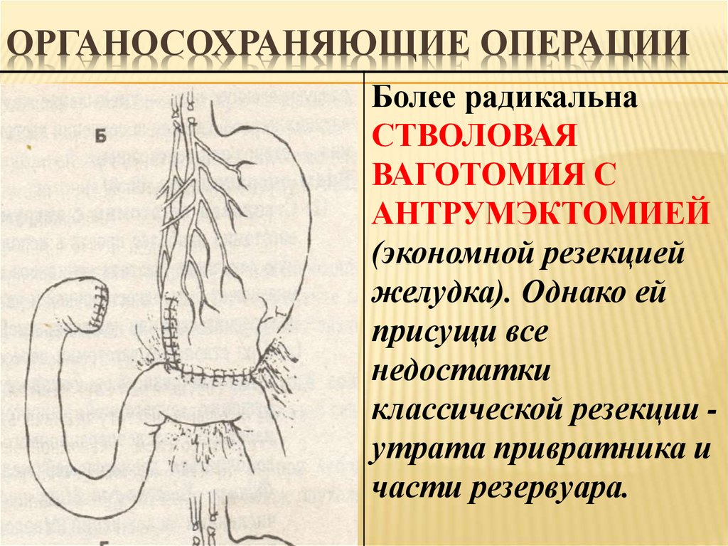 Операция резекция желудка. Стволовая ваготомия с экономной резекцией желудка. Стволовая ваготомия ход операции. Операция Бильрот 2 с ваготомией. Стволовая ваготомия с антрумэктомией ход операции.