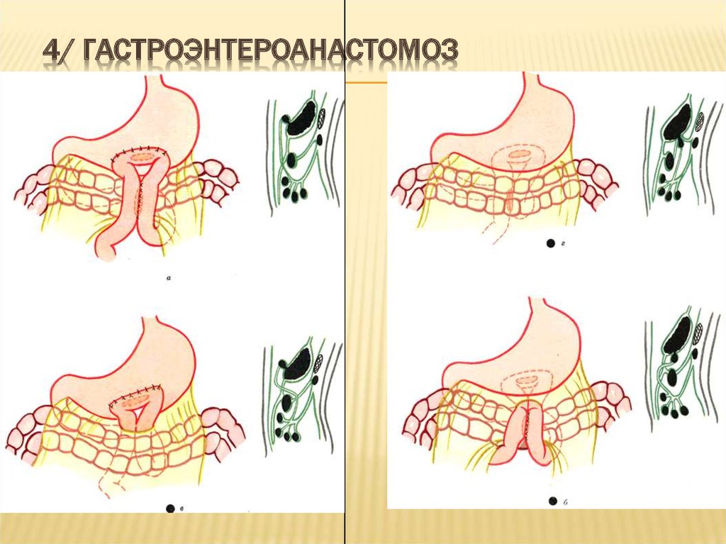 Анастомоз по брауну схема