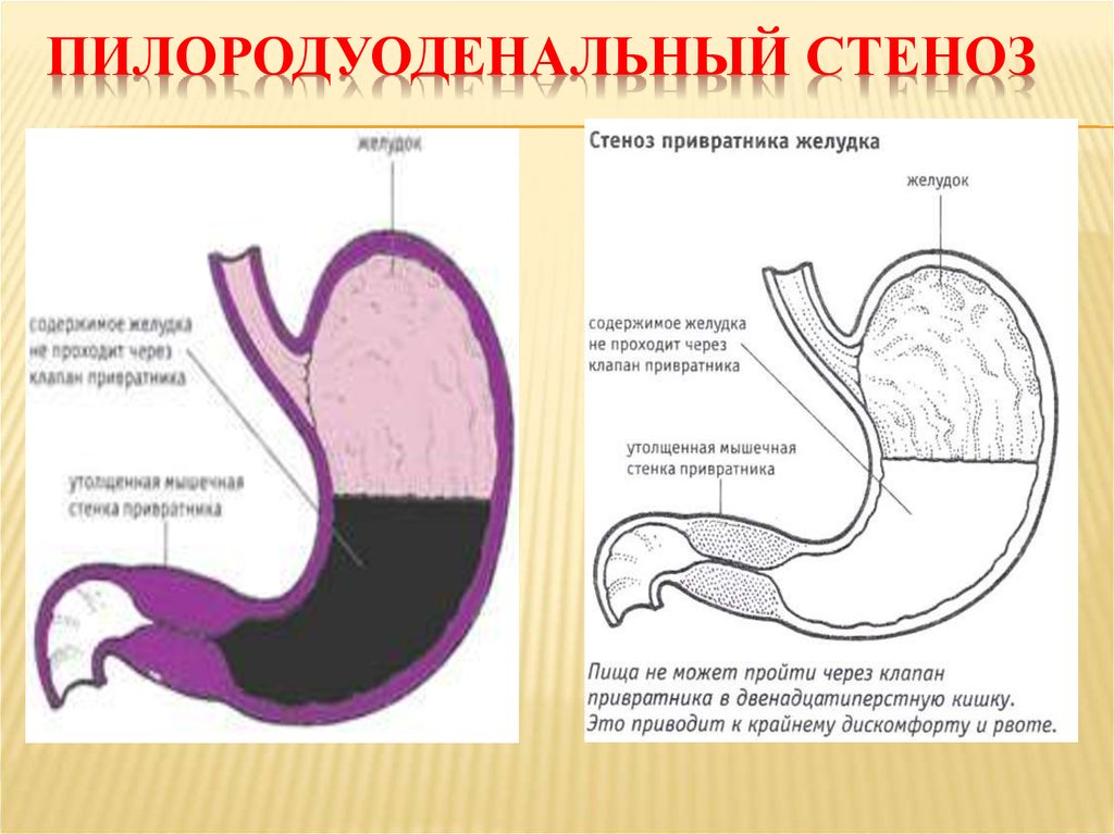 Ямочный рисунок желудка