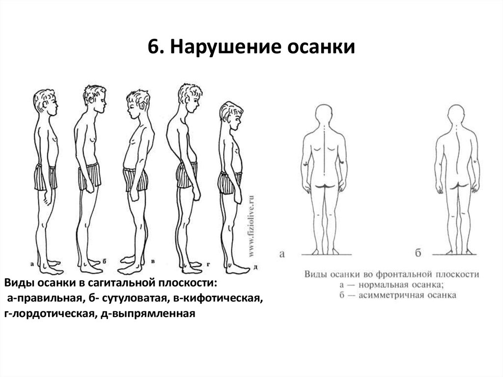 Что не является нарушением осанки. Нарушение осанки. Типы осанки у детей. Виды нарушения осанки. Правильная осанка схема.