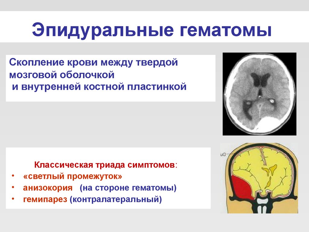Гематома черепно мозговой травме