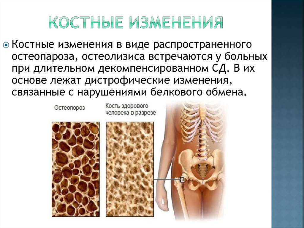 Признаком возрастных изменений костей является. Изменение костной ткани. Возрастные изменения кости. Возрастные изменения костной ткани. Возрастные изменения костных структур.