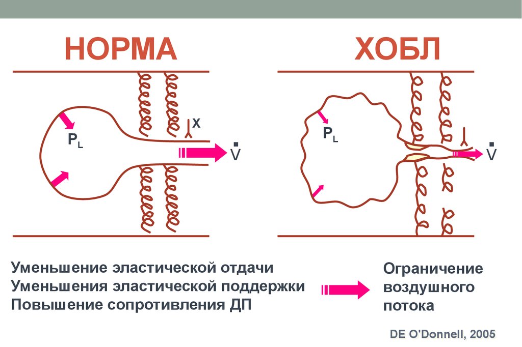 Схема патогенеза хобл