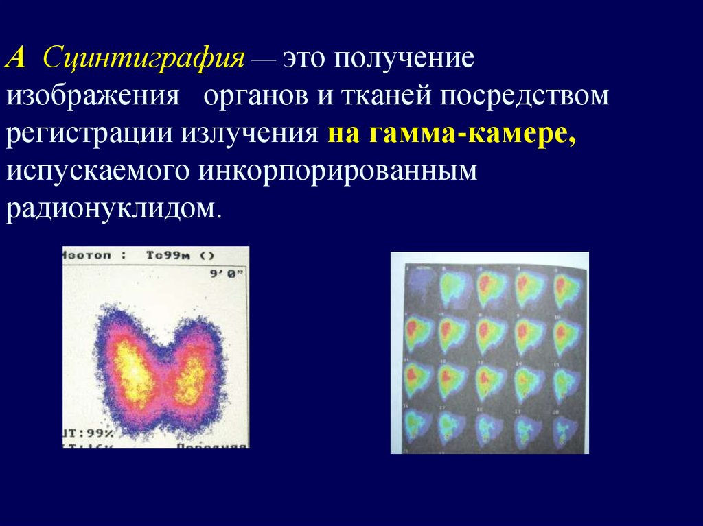 Что такое сцинтиграфия