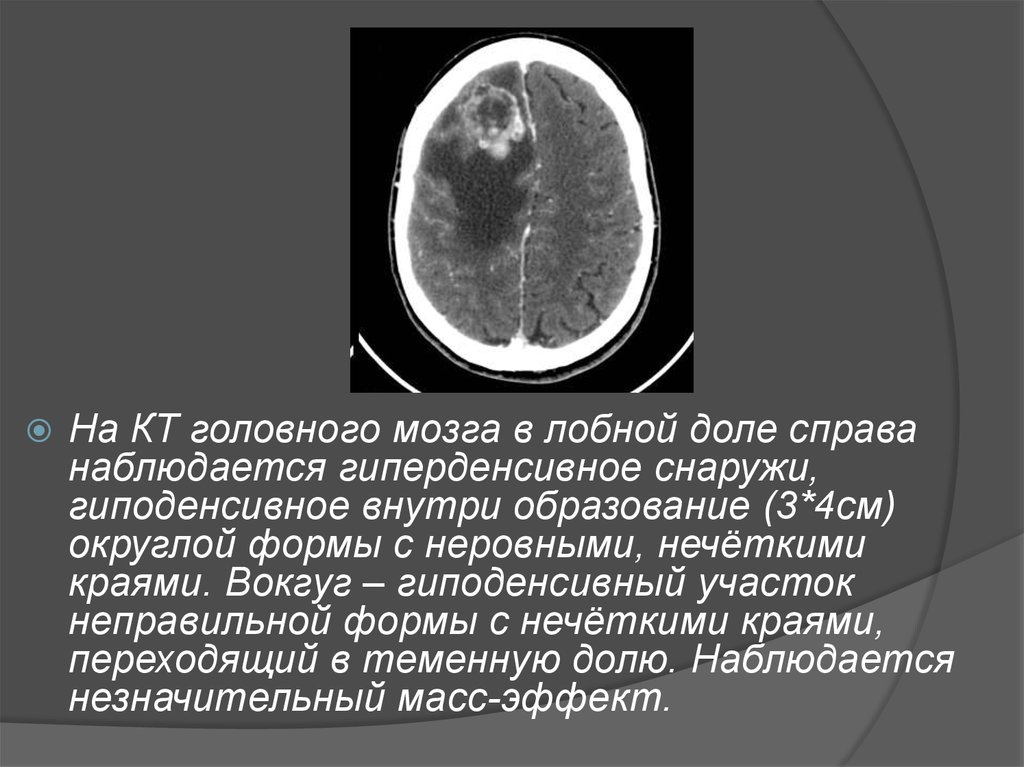 Множественные округлые. Гиподенсный очаг на кт головного мозга. Гиподенсная зона на кт головного мозга. Гиподенсивный участок головного мозга на кт. Гиперденсивный очаг в головном мозге кт.