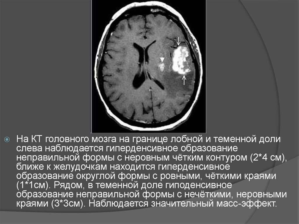 Что значит очаг в головном мозге. Гиперденсивный очаг в головном мозге кт. Гиподенсивные очаги головного мозга что это такое. Гиподенсивные образования головного мозга кт.