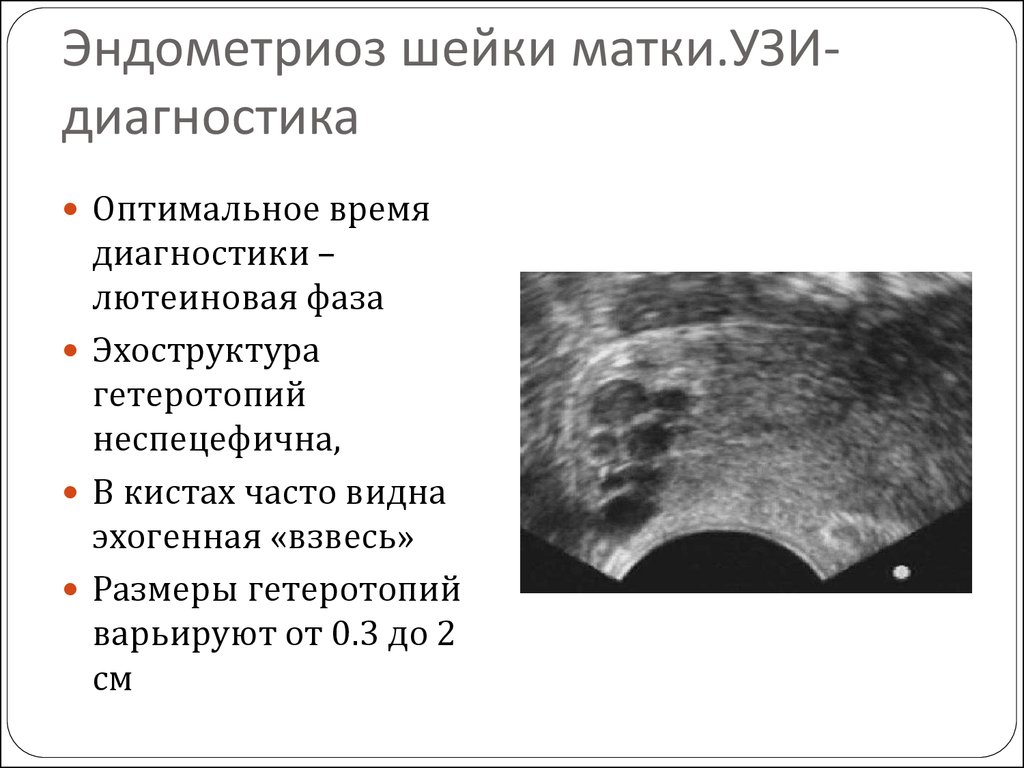 Эндометрия 21. Эндометриоз яичников на УЗИ. Очаговый эндометриоз миометрия. Эндометриоидный очаг шейки матки. УЗИ картина эндометриоза матки.