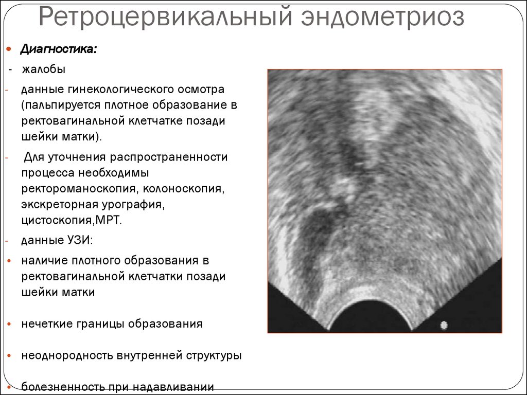 Норма эндометриоза. Ретроцервикальный эндометриоз на УЗИ. Ретроцервикальный эндометриоз дифференциальная диагностика. Эндометриома шейки матки УЗИ. Ретроцервикальный аденомиоз мрт.