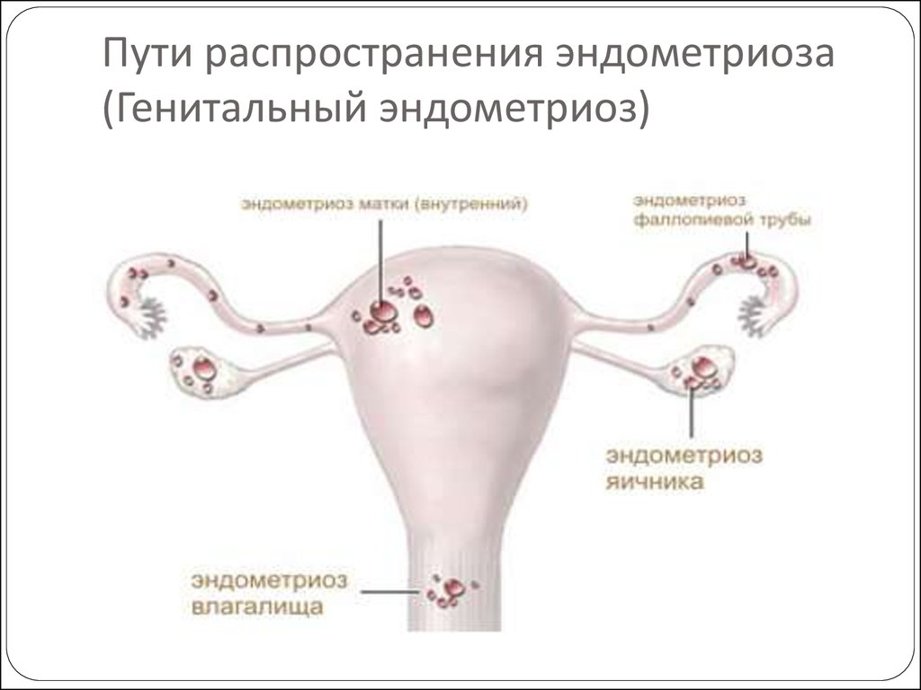 Чем лечить эндометриоз матки у женщин. Наружный эндометриоз шейки матки. По определению генитальный эндометриоз. Наружный и внутренний эндометриоз. Наружный генитальный эндометриоз классификация.