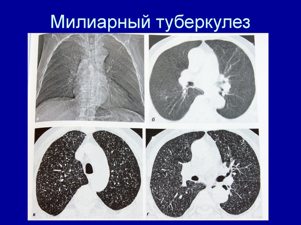 Картина кт при туберкулезе