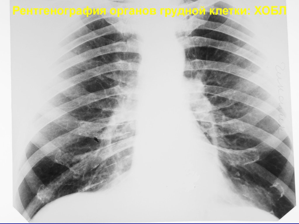 Эмфизема хронического бронхита. Рентген при ХОБЛ эмфизема. Рентгенография органов грудной клетки ХОБЛ. Рентгенография грудной клетки при ХОБЛ. Рентген грудной клетки ХОБЛ.
