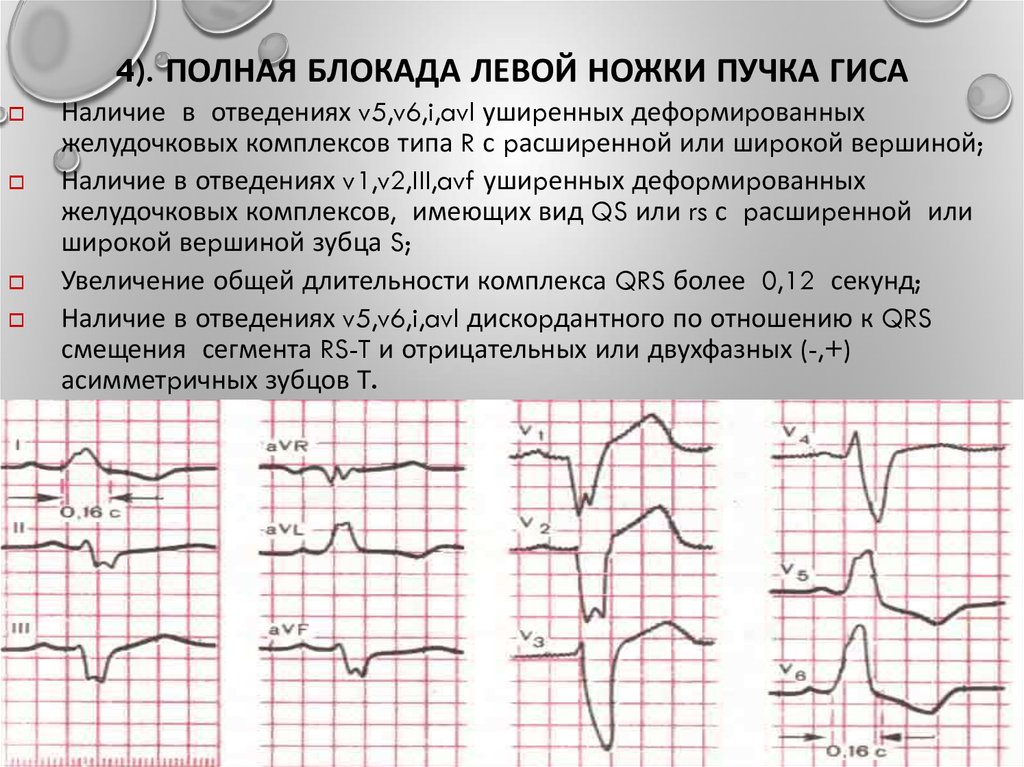 Неполная блокада ножки гиса на экг. Полная блокада ЛНПГ на ЭКГ. Блокада ножек пучка Гиса на ЭКГ. Полная блокада левой ножки Гиса на ЭКГ. Полная и неполная блокада левой ножки пучка Гиса.