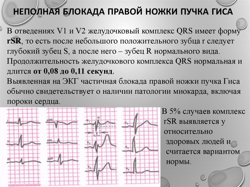 Экг блокада правой гиса. Неполная блокада ножек пучка Гиса на ЭКГ. Неполная блокада ПНПГ на ЭКГ. Неполная блокада правой ножки на ЭКГ. Неполная блокада правой ножки пучка на ЭКГ.