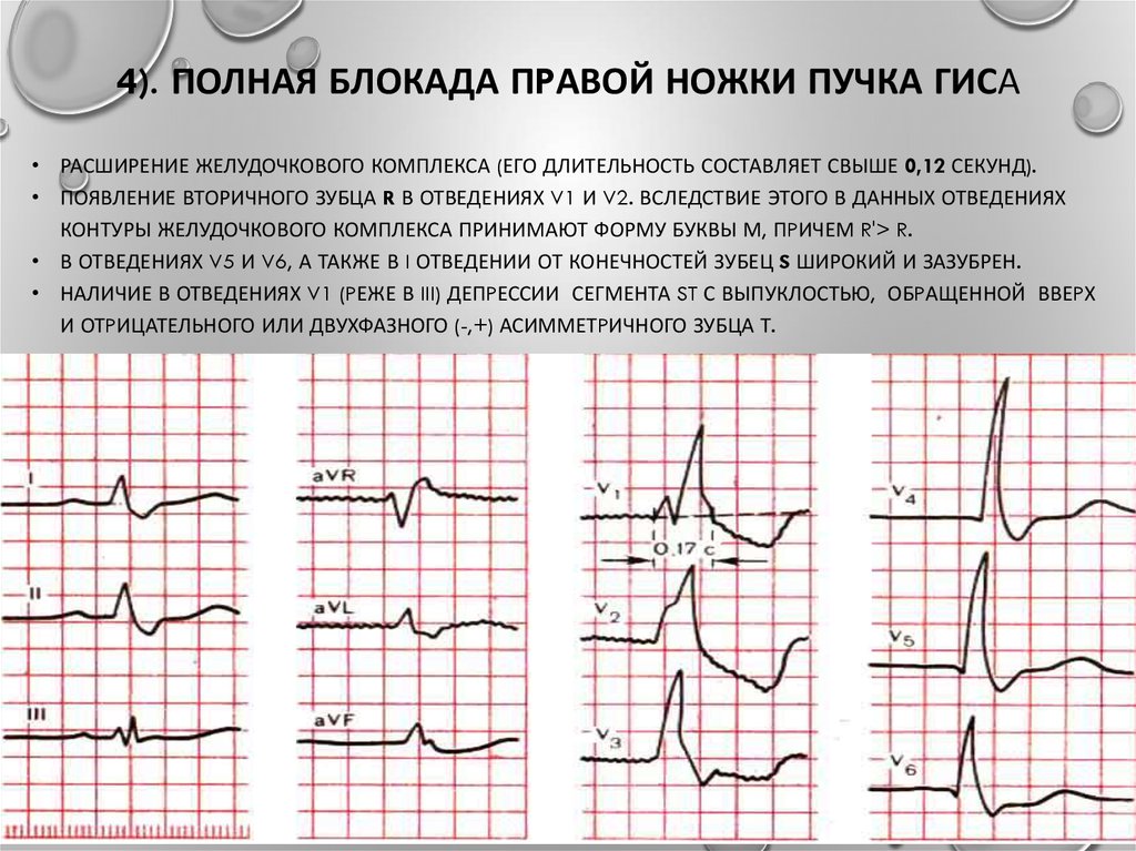 Пучка гиса на экг. Блокада правого пучка Гиса на ЭКГ. Полная блокада ПНПГ на ЭКГ. Блокада правой ножки пучка Гиса на ЭКГ. Полная блокада обеих ножек пучка Гиса на ЭКГ.