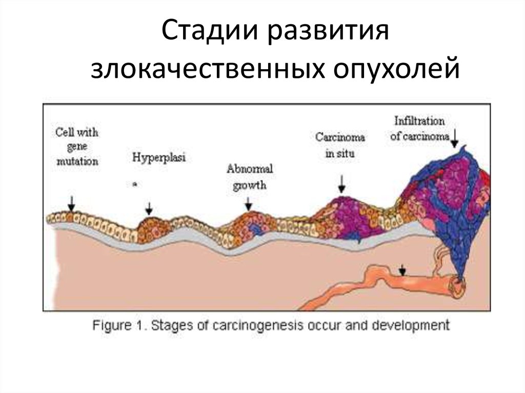 Схема развития опухолей