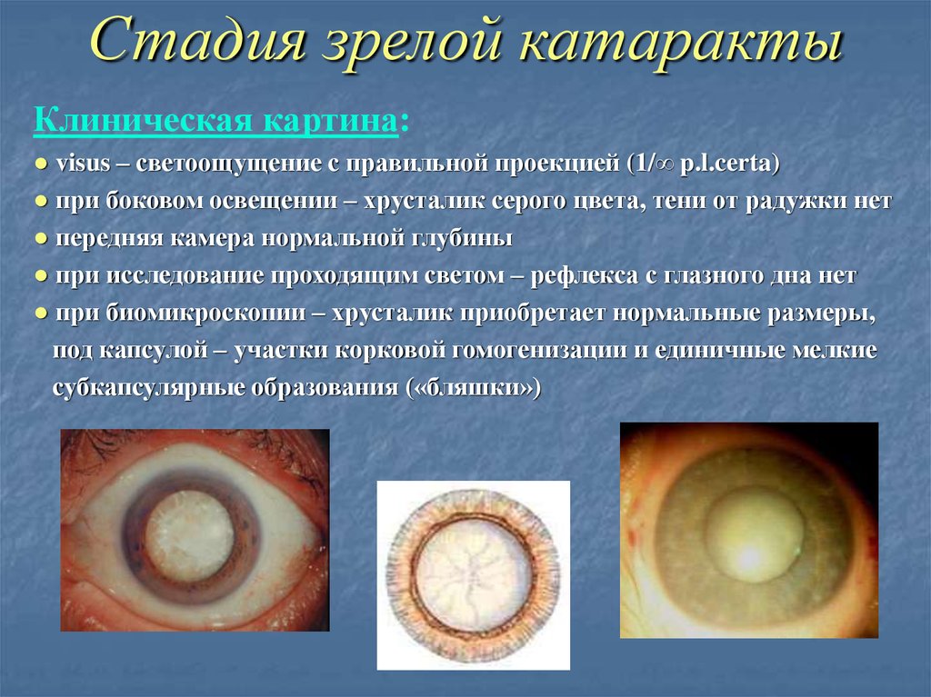 Катаракта глаза симптомы. Незрелая стадия возрастной катаракты. Возрастная катаракта перезрелая стадия. Начальная фаза развития катаракты. Возрастная корковая катаракта.