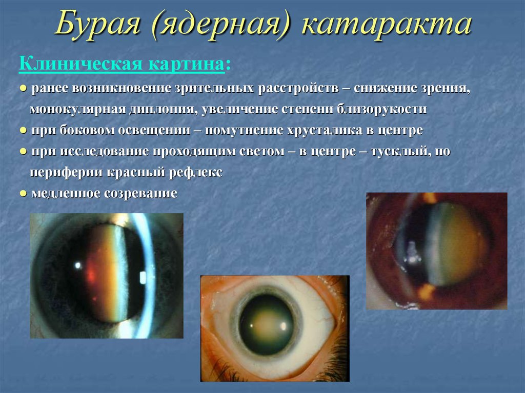 Начальная старческая катаракта. Ядерная бурая катаракта старческая. Врожденная ядерная катаракта. Ядерная катаракта биомикроскопия. Диабетическая катаракта биомикроскопия.