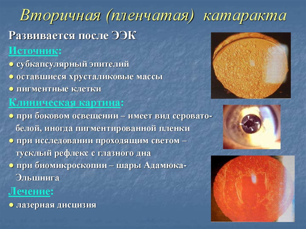 Вторичная катаракта после операции