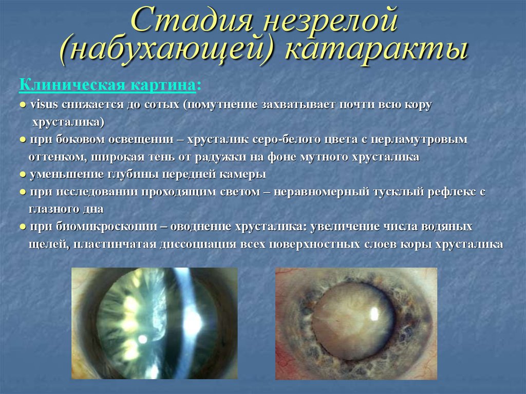 Новгород операция катаракта. Незрелая старческая катаракта. Перезрелая стадия возрастной катаракты. Незрелая катаракта биомикроскопия. Стадии развития катаракты.