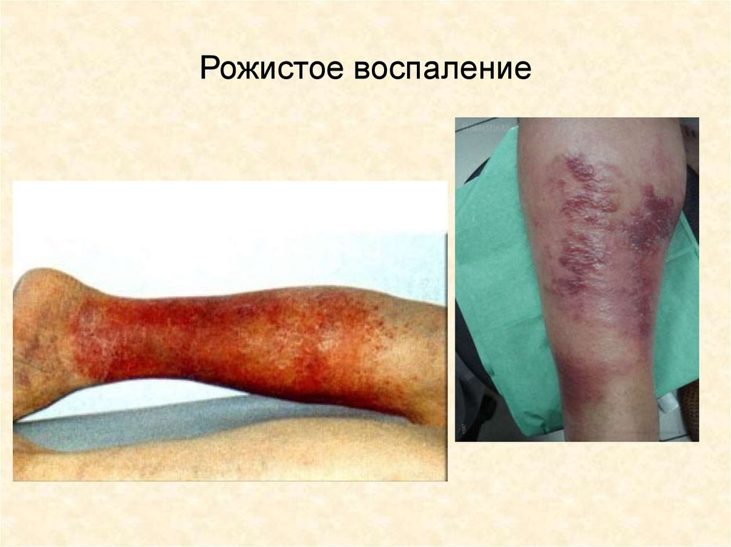 Рожистое воспаление