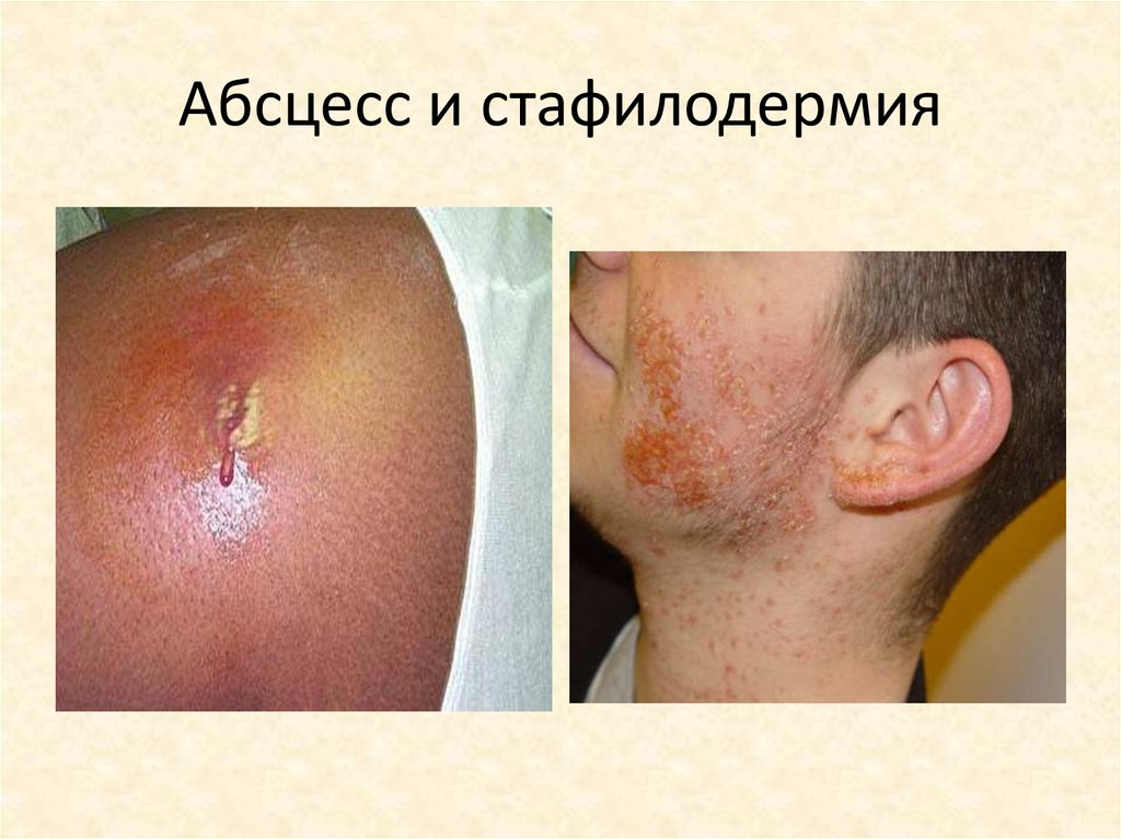 Абсцесс и стафилодермия