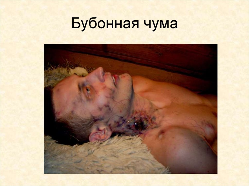 Бубонная чума