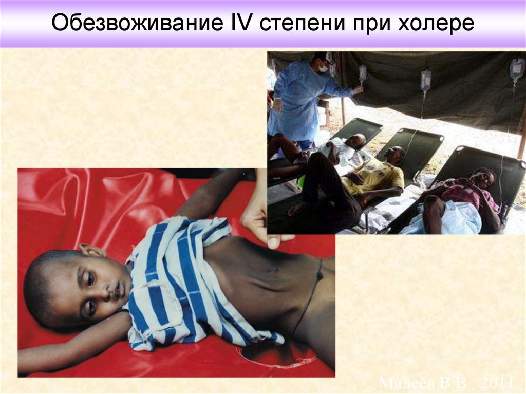 Обезвоживание IV степени при холере
