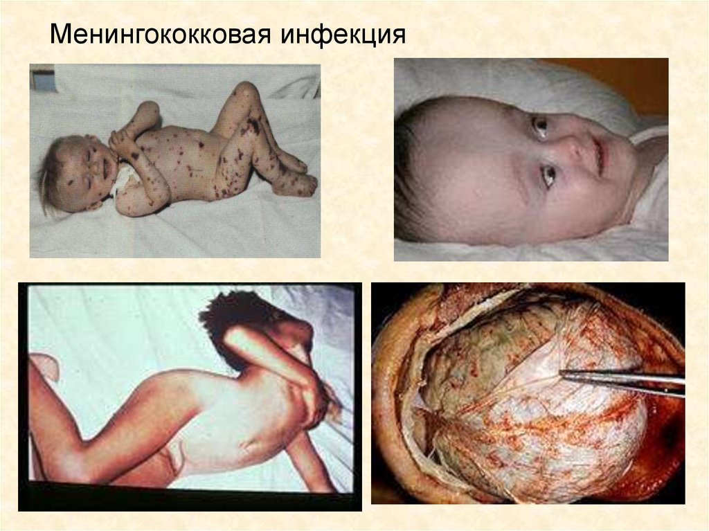 Менингококковая инфекция