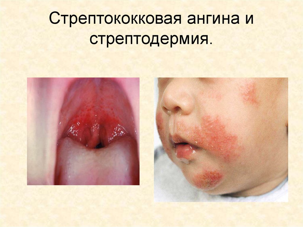 Стрептококковая ангина и стрептодермия.