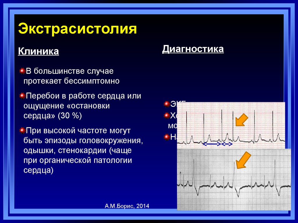 Желудочные экстрасистолы