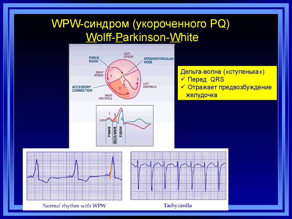 WPW-синдром (укороченного PQ) Wolff-Parkinson-White