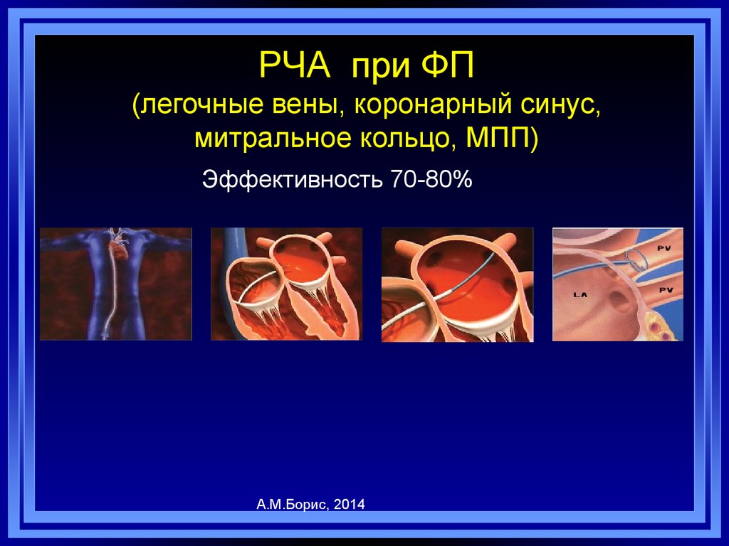 Абляция сердца при мерцательной. Радиочастотная изоляция легочных вен. Радиочастотная катетерная абляция. Радиочастотная изоляция устьев легочных вен. Радиочастотная абляция легочных вен.