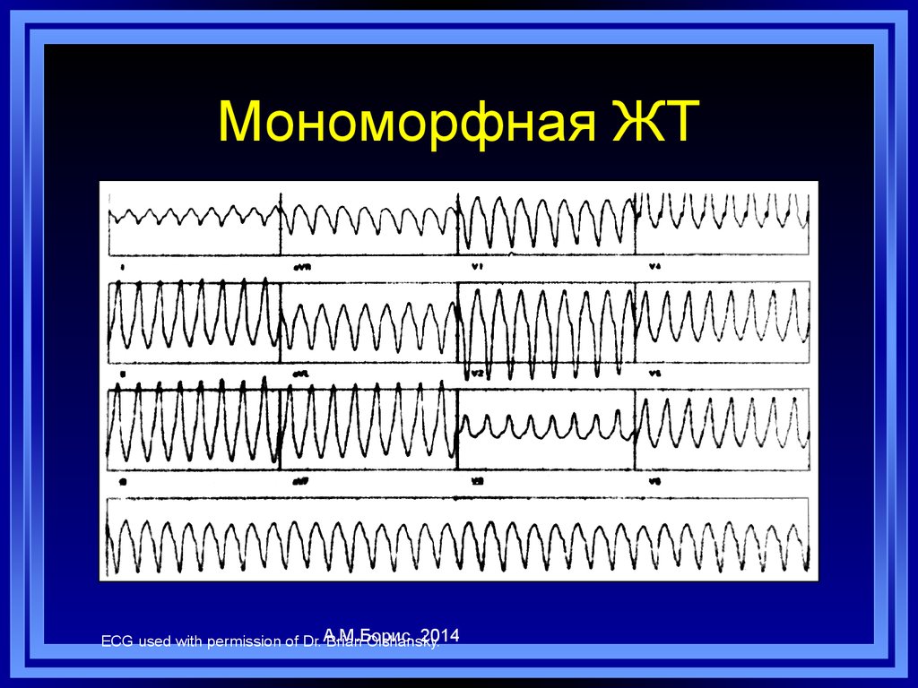 Мономорфная желудочковая тахикардия. Мономорфная и полиморфная желудочковая тахикардия. Мономорфная желудочковая тахикардия ЭКГ. Пароксизмальная мономорфная желудочковая тахикардия ЭКГ. Устойчивая мономорфная желудочковая тахикардия.