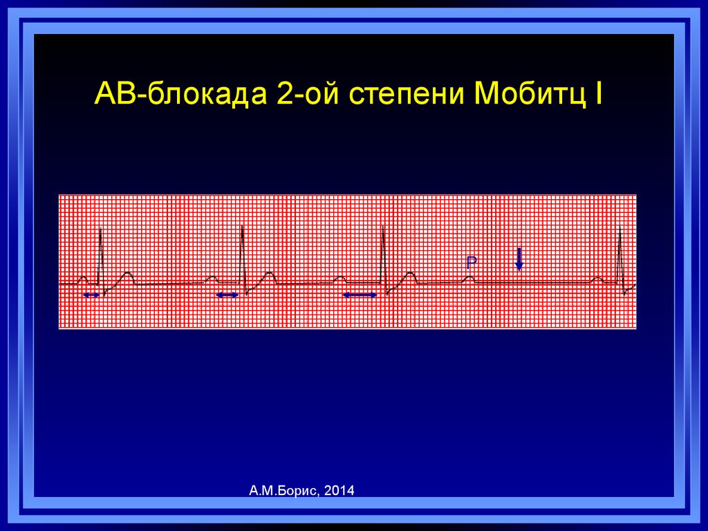 Ав блокада 2 степени. АВ-блокада 2 степени Мобитц 2. АВ блокада клиника. АВ блокада 2 клиника. АВ блокада 2 степени Мобитц 1 клиника.