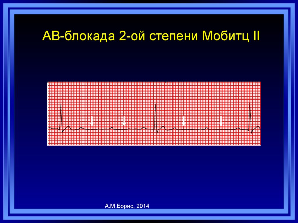 Ав блокада 2. Av блокада Мобитц 2. АВ блокада 2 степени Мобиц 2. АВ блокада 2 степени Мобитц 1 и 2. Av-блокада II степени Mobitz-2.